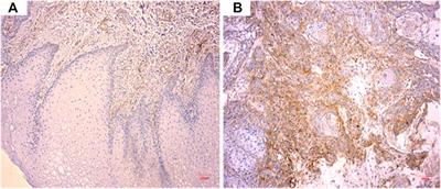 Preparation of Novel ICT-CMC-CD59sp Drug-Loaded Microspheres and Targeting Anti-Tumor Effect on Oral Squamous Cell Carcinoma